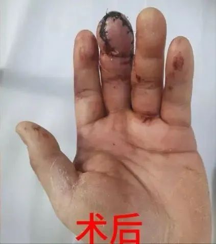 太吓人！男子吃完这种美食险截指！