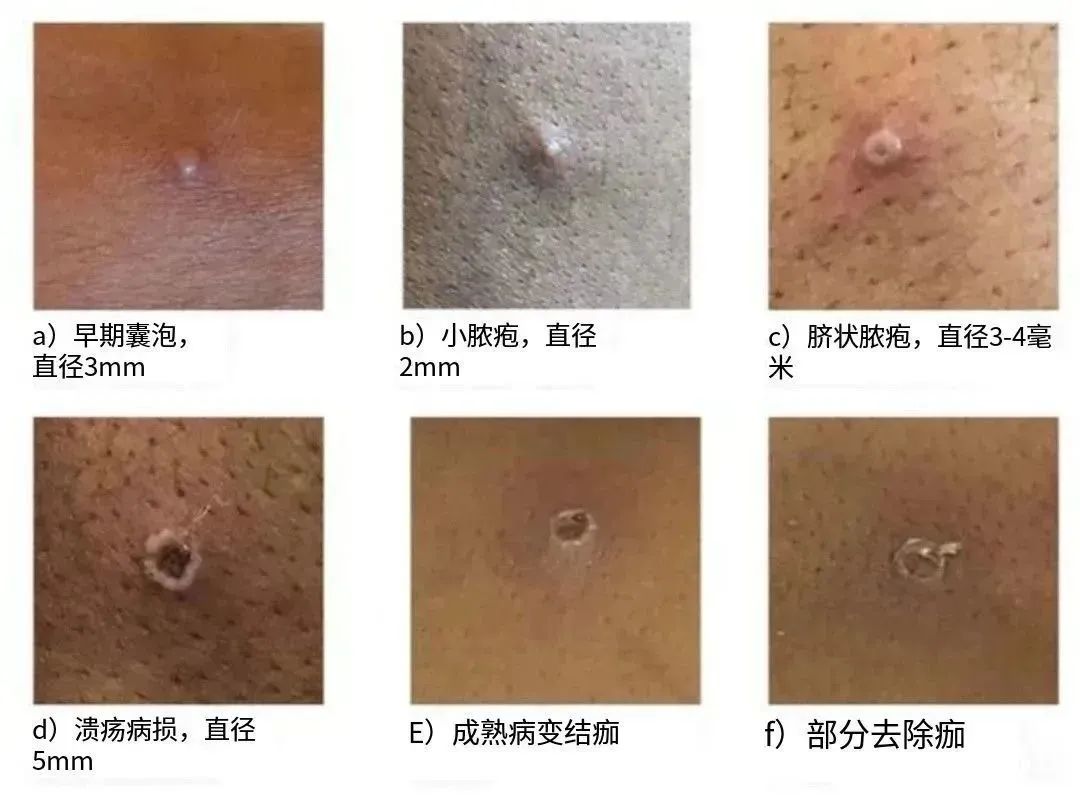 通报！新增确诊501例，98.9%为男性！福建新增7例！