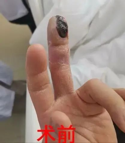 太吓人！男子吃完这种美食险截指！