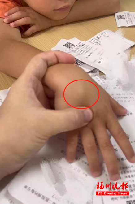 9岁男孩打“烟卡”导致腱鞘囊肿