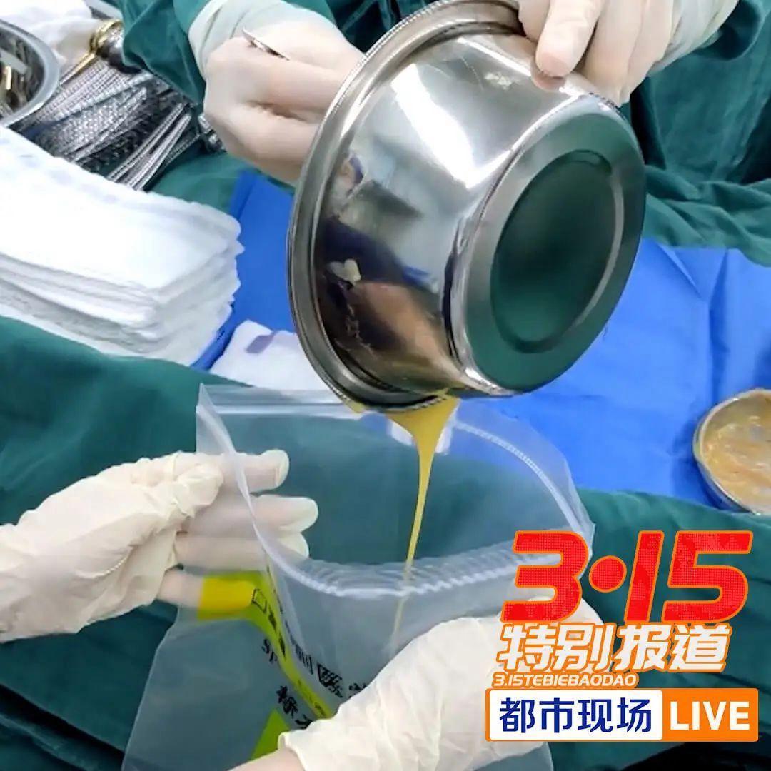花239万自体丰胸检出黄牛驼鹿DNA
