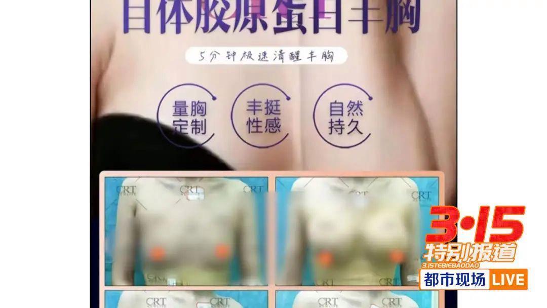 花239万自体丰胸检出黄牛驼鹿DNA